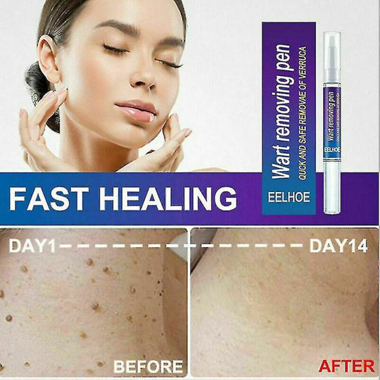 Warts Remover Original Cream (Original)