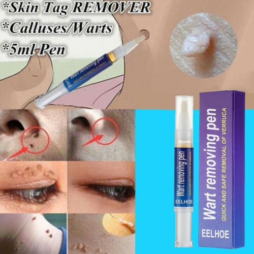 Warts Remover Original Cream (Original)